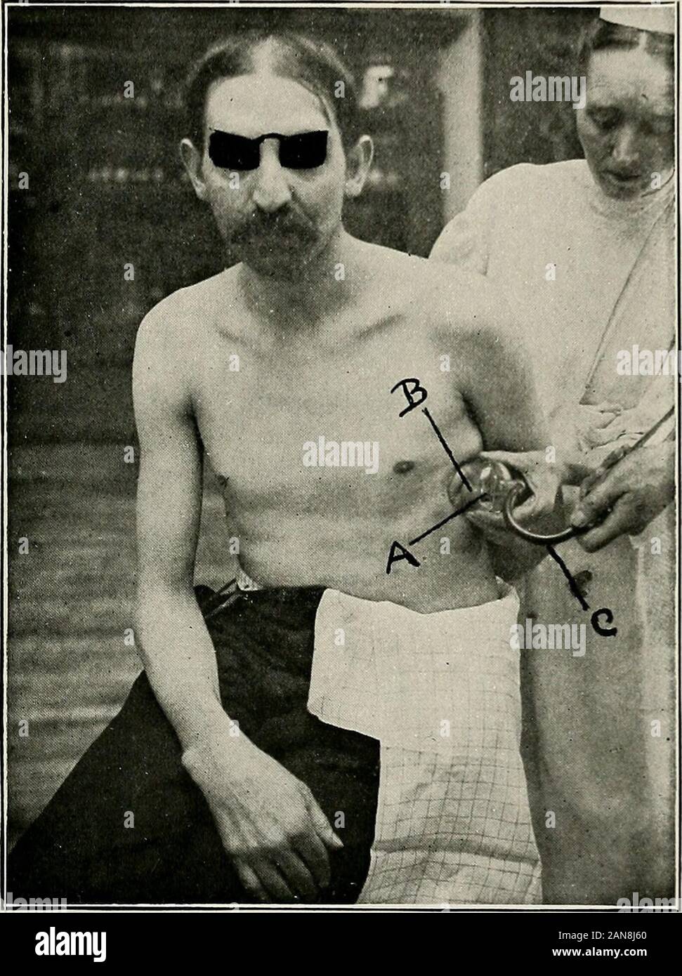 Coller dans les suppurations chroniques de bismuth, son importance diagnostique et thérapeutique . e les sécrétions, et donc une systematicexamination de même est nécessaire. La pression négative pour ré-expansion du poumon. À la suggestion de M. Carl Beck J'ai récemment em-tion un moyen pour reexpansion sous contrat de poumon. Thetechnic est ici illustré : M., âgé de 31 ans, élaboré en 1900, à destination de la pleurésie aiguë em-pyema. Après plusieurs écoutes téléphoniques de fluide, le drainage avec un tubewas caoutchouc établie. L'empyème s est avéré d'origine tuberculeuse, thebacilli ont constamment été trouvés dans la cavité pleurale d Banque D'Images