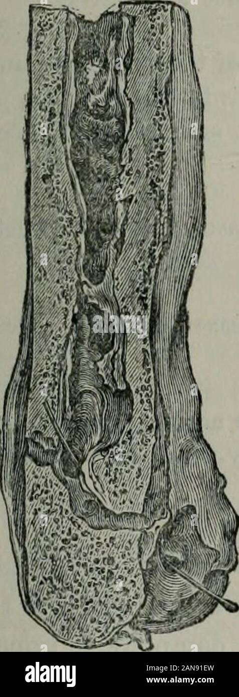 SurgeryExtracts clinique de la pratique chirurgicale des rapports entre les années 1860-1876Traduit de l'original, et édité, avec des annotations, par sawingthpough CTDent . sur l'os, que la cavité médullaire contenues ; ce pus, cependant, seulement prolongée d'un quart de pouce au-dessus de la section, et j'ai donc l'éliminaient. Les volets United en première intention, mais deux sinuseswere gauche, l'un sur l'extérieur et l'autre sur le côté intérieur de la plaie, whichled jusqu'à la cavité médullaire, d'où aucune empreinte jusqu'granulationssprang. Finalement, après le retrait d'un pouce et subperiosteally Banque D'Images