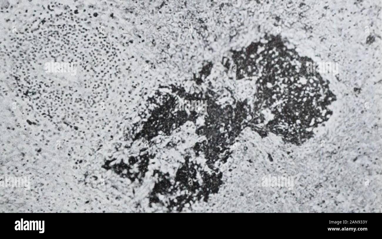 Petechial Banque De Photographies Et D Images A Haute Resolution Alamy Petechial Banque De Photographies Et D Images A Haute Resolution Alamy