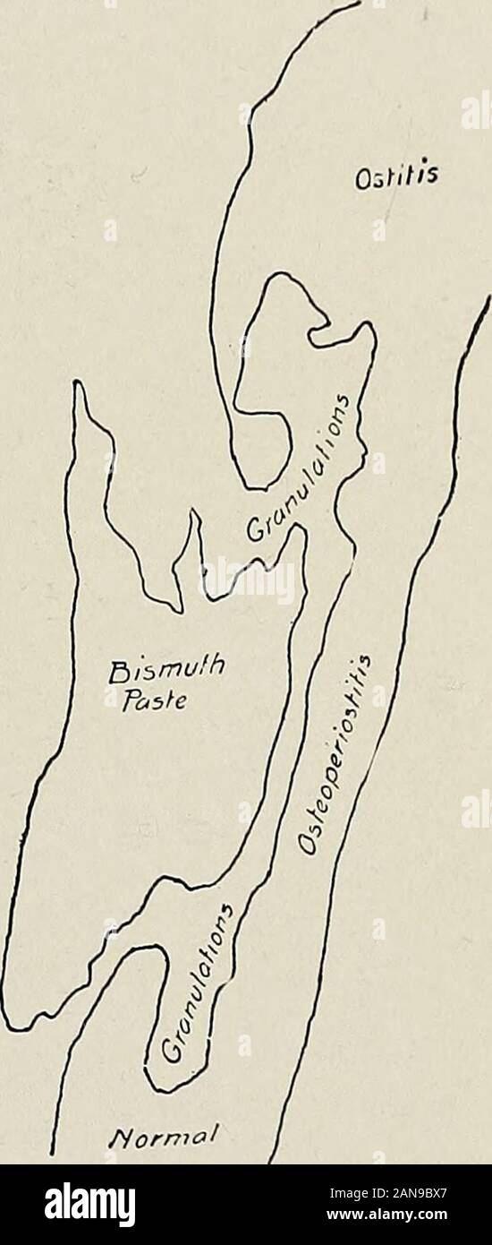 Coller dans les suppurations chroniques de bismuth, son importance diagnostique et thérapeutique . Fig. 19. Le bismuth coller injectée dans la cavité après séquestres ont été supprimés.(cas de la Fig. 16.) LES SINUS suite à d'autres maladies. 70. Fig. 19 A. illustration schématique de la Fig. 19. 76 Dans les suppurations chroniques PÂTE DE BISMUTH. Banque D'Images