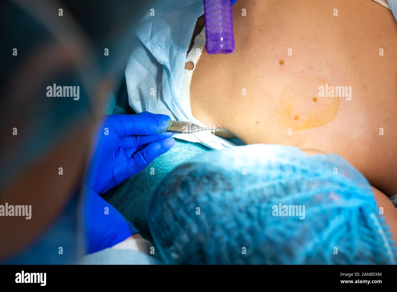 Close-up chirurgien burns une taupe sur le dos du patient. Procédure de chirurgie de déplacement de taupe. Banque D'Images