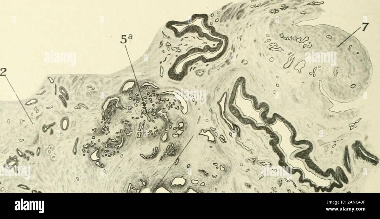 Les fibromes tumeurs et alliées (myome et adenomyoma) : leur pathologie, les caractéristiques cliniques et le traitement chirurgical . cribed deux cas d'adenomyoma du ligament ovarien. Dans le premier cas la glande-spacesran dans le hile de l'ovaire gauche le long de l'wholelength du ligament élargie pour atteindre, et pénétrer, thewall de l'utérus (voir Fig. 194). Sur le côté droit, theovarian contenues ligament glandes qui couru dans theuterine mur. Sitzenfrey considéré la glande (epoophoritic asWolffian-structures). Ce même auteurs deuxième cas était celui d'une tumeur7 ^ ^ S-S 7-^S ^^- j'^^^^ qui apparurent à partir de t Banque D'Images