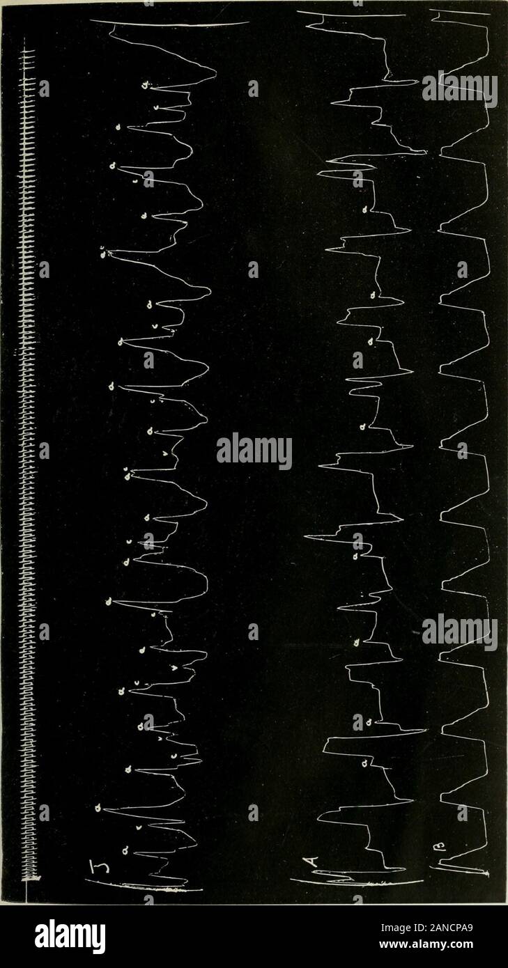 Archives de médecine interne . • 314, LES ARCHIVES PUBLIQUES DE L'INTERXAL MEDICIXE stimuli individuels. Après une période variable, en raison, peut-être, à une somme-tion de stimuli ( ?) il se produit une apparenth ventricularcontraction spontanée. Cette contraction spontanée élimine les déchets produits andimproves la circulation et l'alimentation du muscle cardiaque  =o que le ventricule est à nouveau reposé ahle à répondre à chaque stimulus comme il arrivesthrough auriculoventricular la l)undle. Mais après un certain nombre d'ofbeats, avec le retour d'une vague de l'activité du nerf vague, le taux d'auriinUar isslowed et le cont Banque D'Images