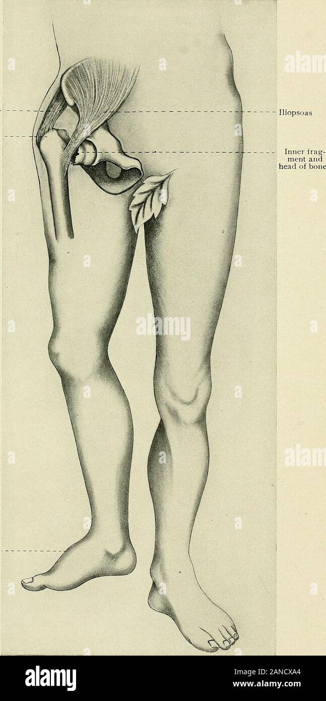Un texte-livre d'anatomie clinique : pour les étudiants et les praticiens . Le muscle psoas iliaque en tête avant de l'ob-turator foramen Fig. 144.-l'avant de la hanche luxation et fracture au milieu de l'arbre du fémur show-ing action des muscles du bassin et de la partie supérieure de la hanche (obturateurs, psoas iliaque, etc.), le incausing la fragment à être tiré vers le haut et vers l'extérieur, et la partie inférieure de tobe fragment tiré vers le haut et vers l'intérieur par les muscles adducteurs. Fait à partir de # -ray photo. 45i'Action de ro tators d'élévation de la hanche trochanter au-dessus de Roser-Nelaton offoot éversion de la ligne. Fig. 145.-Fracture du col du fémur (à partir de la x-ray Banque D'Images