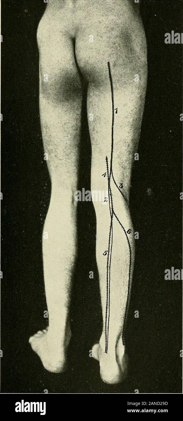 Un texte-livre d'anatomie clinique : pour les étudiants et les praticiens . Fig. 135.-Angle d'adduction de la hanche-joint ; tendon-cheville-ancragedu gaines autour de l'avant et à l'intérieur du pied et bursas rotulien. 1, tendon-gaine du tibialis anticus.2, gaine de tendon-muscle hallucis longus. 3, tendon-gaine du ex-par lequel tenseur. 4, tendon-gaine du tibialis posticus, derrière laquelle liesa court-tendon-gaine pour le flexor digitorum longus et flexor hallucis longus. 5, pré-bursa rotulien. 6, Bursa entre l'insertion de la patella ligamentum ? Tubercleof et le tibia. 7, une Banque D'Images