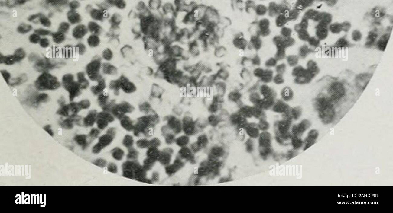 Le Journal de la médecine clinique et laboratoire . ofepithelium otally érodé, sauf pour les bases des cryptes. Il n'y a pas d'atrophie marquée de la musculeuse comme est décrit par la plupart des écrivains et la pigmentation brune ismuch moins importante que certains journalistes ont trouvé. Le apparatusof lymphoïdes l'intestin est atrophique plutôt. Contrairement aux résultats de certains autres ob-serveurs, les patchs sont Peyers et atrophique possèdent peu de centres germinatifs. Noulcerations ont été trouvés n'importe où m le tractus intestinal, sauf à l'anus. Thelarge intestin présente les mêmes changements que les autres parties de l'intestina Banque D'Images