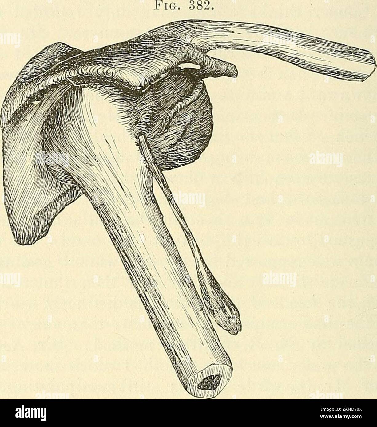 Un traité pratique sur les fractures et luxations . Il a quitté la cavité glénoïde est couvert par le untorn la moitié antérieure du ligament capsulaire, qui est étendue sur la surface articulaire, holdingthe la tête tout contre le bord postérieur de la Fossa, et par son fiberscausing inférieure la position avancée de l'extrémité inférieure de l'humérus, qui est socharacteristic de l'accident. La rotation interne détend cette untorn dela partie ligament, comme le fait aussi une position plus avancée encore du coude avec thehumerus élevé à une position horizontale. Pour une réduction de la luxation de l'outildoivent Banque D'Images