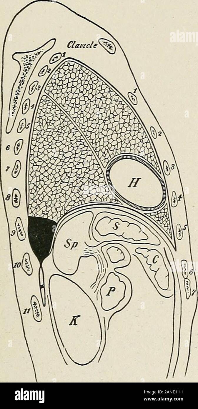 Les maladies de la poitrine et les principes de diagnostic physique . FiG. 351.-apical localisé l'empyème. {Dr D. R. Bowen.) hesions entre les poches de formage et viscérale la pariétal de thepleura^-ers. Celui-ci peut se produire à tout moment dans le sac pleural butare trouvés plus commonlv dans la partie inférieure et postérieure de la poitrine(voir fig. 350, 351, 352, 353). Dans la mesure où une collection de pus dans l'une des fissures interlobaires estpas rare, il est important de garder à l'esprit la position de thesefissures. Fig. 354 et 355 montrent leur emplacement. Fig. Montre 355 thecomplementary espace pleural posteri Banque D'Images