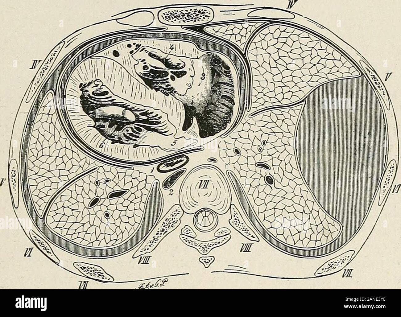 Les maladies de la poitrine et les principes de diagnostic physique . Fig. 346. -L'empyème enkystés dans partie inférieure de la poitrine. Remarque l'aplatissement et posi-tion faible du diaphragme et le déplacement vers le bas du foie. une bronche ou il peut se rompre à l'extérieur à travers la paroi thoracique-em-pyema necessitatis (voir Fig. 348). L'infection de deux simultaneoush^ sacs pleural est très rare. J'havemet avec l'un de ces cas où une croupous wasfollowed la pneumonie bilatérale par un épanchement purulent bilatéral. Dans l'examen de l'anatomie morbide de la pleurésie il a été souligné que les maladies de la plèvre 593. -^^^ F Banque D'Images
