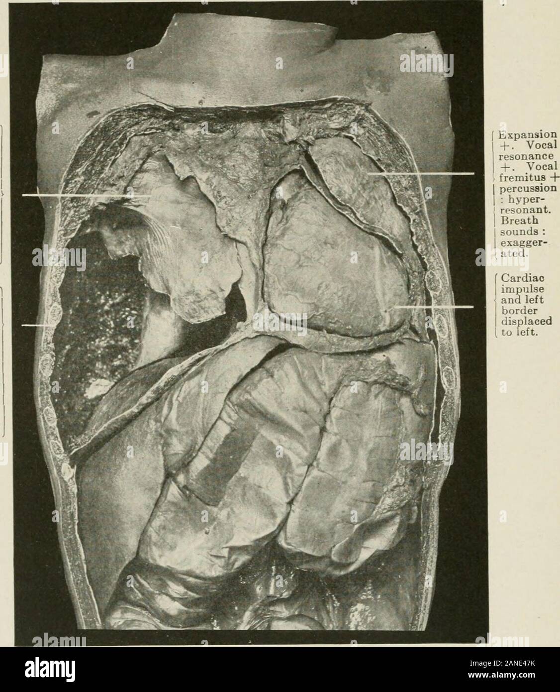 Les maladies de la poitrine et les principes de diagnostic physique . pitchedtympany Breathsounds, :,.bronchoconstriction d'expansion vésiculaire 1- • Vocalfremitus espaces plein.O.reso-nance Vocal O-percussiondulness Breathsounds. +  +  + O-Phrenicshadow O. Fig. 346. -L'empyème enkystés dans partie inférieure de la poitrine. Remarque l'aplatissement et posi-tion faible du diaphragme et le déplacement vers le bas du foie. une bronche ou il peut se rompre à l'extérieur à travers la paroi thoracique-em-pyema necessitatis (voir Fig. 348). L'infection de deux simultaneoush^ sacs pleural est très rare. J'havemet avec l'un de ces cas dans lequel un bilater Banque D'Images