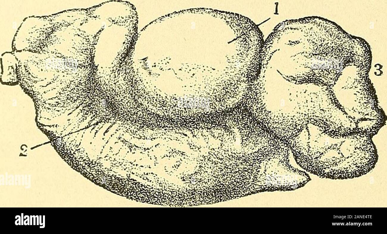 Traité de gynécologie : soins médicaux et chirurgicaux . aneis de couleur ardoise. L'orifice externe est toujours oblitered- 16 et quelques GYJST CLINIQUE ET OPÉRATIONNEL.L'écologie. fois adhère plutôt vague à l'ovaire. L'orifice de l'utérus, sur thecontrary, est généralement perméables. La lésion a été aussi calledpachy-salpingitis salpingitis interstitielle, ou en raison de l'augmentation des tissus inconnective comme indiqué par le microscope. Il est analogue à l'épididymite tochronic la dégénérescence de la sclérotique cordon spermatique.Deux variétés anatomiques de cette affection peuvent être reconnues, whichcorrespond avec ceux de paren Banque D'Images