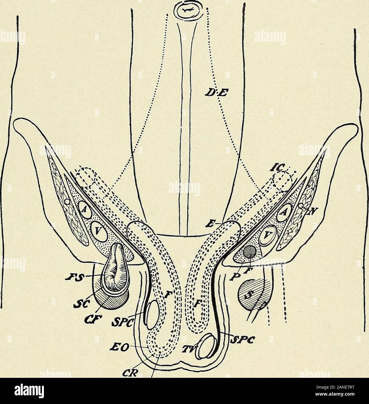 Un texte-livre d'anatomie clinique : pour les étudiants et les praticiens . Hernie indirecte.-comme une hernie entre avec le cordon spermatique à l'anneau interne, le cordon de mentir à ses côté intérieur et derrière. Il traversesthe canal inguinal et passe à travers la bague extérieure dans le scrotum.Il peut être congénital ou acquis ; l'ancien, de la non fermeture du processus d'thevaginal le péritoine, qui accompagne normalement thespermatic et cordon dans la descente des testicules (voir Fig. 78). Cette congenitalhernias sont le plus souvent mis au point après la naissance, lorsque le tunica vag-inalis testis est presque formé, et sont Banque D'Images