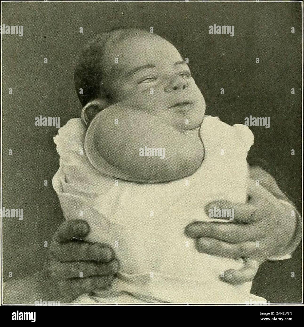 Ganglion Sous Maxillaire Banque D Image Et Photos Alamy Ganglion Sous Maxillaire Banque D Image Et Photos Alamy