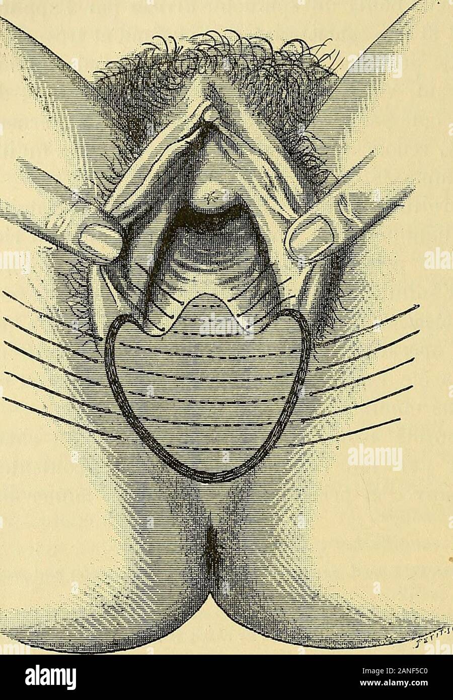 Traité de gynécologie clinique et opératoire . préconisé, de son côté, le dédoublement commemode davivement ; procédé unique fils de suture, diffère du reste, téléphonique totalement de celuide L. Tait. Parmi les chirurgiens qui ont adopté plus ou moins complètement le procédé de L. Tait,je citerai, outre Sanger : Zweifel (Deutsche Med. Wochenschr., 1888, n° 31).- Meinert(Centr. f. Gyn., 1888, n°41). - Rokitansky (Wiener Min. Wochenschr., 1888, n° 11).- Schauta, Piering, Riedinger (ibid., n° 26, 1888). - Winiwarter (ibid., 1888, n°s 51 et 53). - Schubert. Dissert, inaug., Greifswald, 1888. -A.Martin (Berliner Banque D'Images