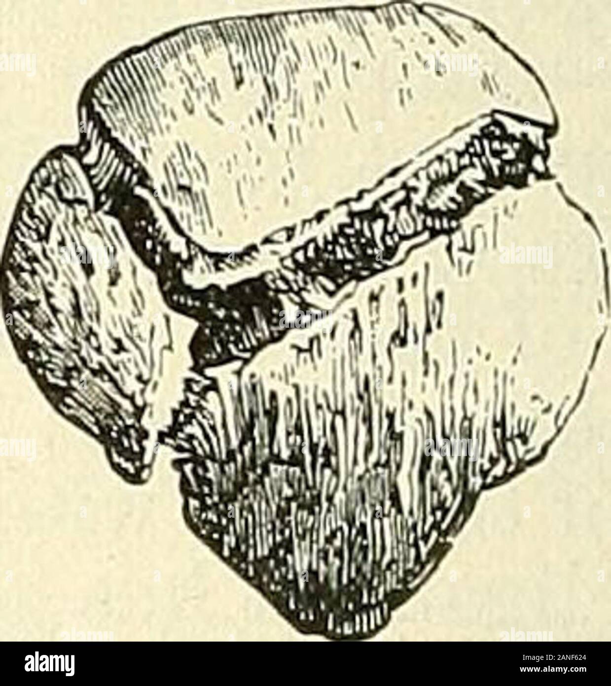 Un traité pratique sur les fractures et luxations . Fracture transversale simple. Fracture comminutive. ment la fracture, dans toutes les fractures transversales simples, et à de l'leastone en fractures comminutives. Mes raisons de cette opinion sont : thegreat pouvoir de ces quatre muscles puissants qui s'unissent pour former le tendonof le quadriceps-le fait que quatre-vingt-dix-neuf s'est produite chez les mâles-que onlythree sont survenus chez des personnes âgées de moins de vingt ans, et cinq seulement après le soixantième année - le plus grand nombre d'être andthirtieth entre le 20ans de vie-la remarquable uniformité dans le sens de la Banque D'Images