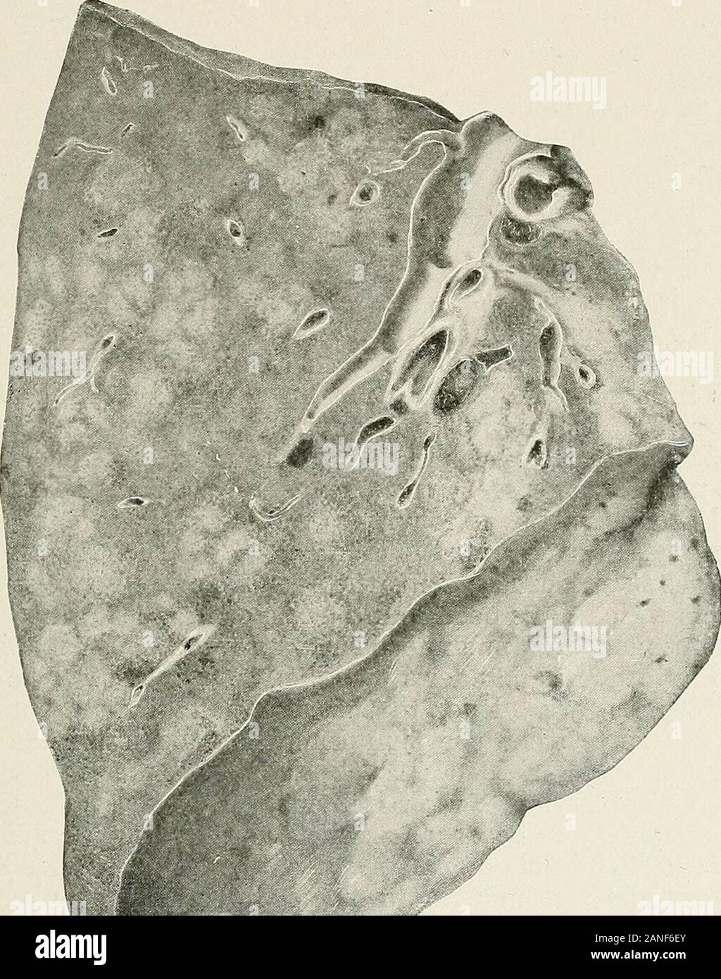 Les maladies de la poitrine et les principes de diagnostic physique . ne fait pas exception. Anatomie morbide.-l'affection est presque toujours des lésions bilatérales, bien que le risque d'être beaucoup plus vaste d'un côté que de l'autre. Holtfound la maladie bilatéral dans 82  % des cas, de venir à l'autopsie.La maladie a une préférence marquée pour l'aspect postérieur de l'lowerlobes. Le lobe moyen du poumon droit est la partie la moins touchée. Un poumon le siège d'un processus de broncho-pulmonaire est plus lourd que la normale, MALADIES DES POUMONS congestionnés et profondément 431 alors que, tout au long de crepitant révèle à la tou Banque D'Images