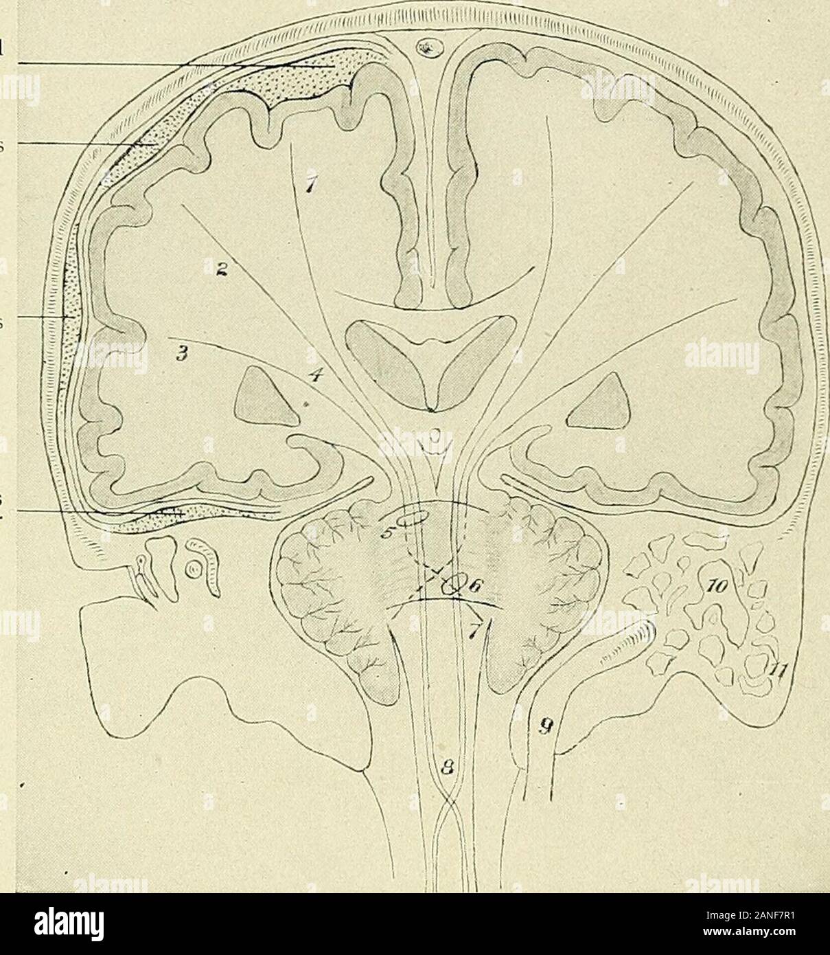 Un texte-livre d'anatomie clinique : pour les étudiants et les praticiens . Nerf optique nerf olfactif de l'artère carotide interne nerveAuditory nerveVagus nerveGlossopharyngeal nerveSpinal Facial nerf accessoire sinus sinus sigmoïde nerf hypoglosse nerveLateral Fig. 8. à la base du crâne, du rapport montrant des nerfs crâniens, au milieu de la carotide et de l'meningealarteries, et les sinus de la fosses nasales. Cette illustration présente sur le côté droit du crâne le mostfrequent lignes de fracture à la base du crâne. 31 Pia-arachnoiisuppuration focus sous péridurale péridurale focu focusin moyen-eardisease. Fig. 9.-Coron Banque D'Images Un texte-livre d'anatomie clinique : pour les étudiants et les praticiens . Nerf optique nerf olfactif de l'artère carotide interne nerveAuditory nerveVagus nerveGlossopharyngeal nerveSpinal Facial nerf accessoire sinus sinus sigmoïde nerf hypoglosse nerveLateral Fig. 8. à la base du crâne, du rapport montrant des nerfs crâniens, au milieu de la carotide et de l'meningealarteries, et les sinus de la fosses nasales. Cette illustration présente sur le côté droit du crâne le mostfrequent lignes de fracture à la base du crâne. 31 Pia-arachnoiisuppuration focus sous péridurale péridurale focu focusin moyen-eardisease. Fig. 9.-Coron Banque D'Images