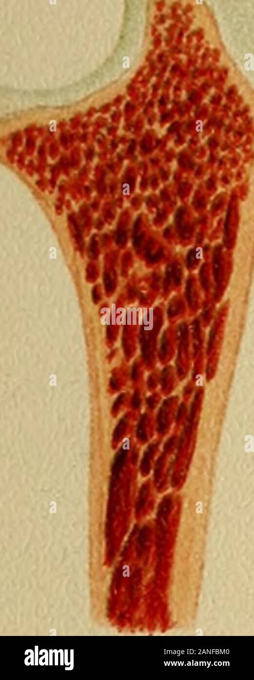Atlas et exemple même de fractures et luxations traumatiques de l'rdre . surface fracturée correspondant à aslight visible sur la projection de fragments supérieur. La projection et la perte de substance ne sont pas en face de l'autre ; l'extérieur rota-tion de la partie supérieure de fragment (supination) ayant causé l'projectionto se déplacer dans presque 180 degrés. La leçon à tirer est que, même dans fromthis fracture isolée du rayon du bras d bedressed en supination ou pronation supination et à mi-chemin entre. Fig. 3.-l'épiphyse des os qui entrent dans la formation de l'articulation du coude, montrant var Banque D'Images