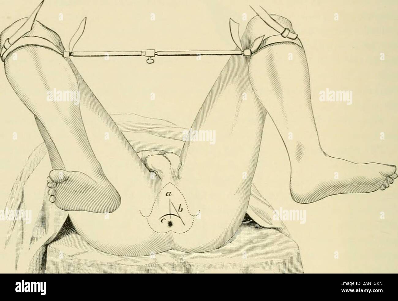 La chirurgie opératoire . f est alors retirée, et l'ASEP-ticized l'index de la main gauche s'effectue par le col des thebladder le long de la directrice avec un semirotary motion visant à compléter le dilata-tion. La pince est alors introduit, la pierre pris à sa courte diame-ter, et enlevée par traction progressive, régulière, qui peut être accompagnée de mouvements byrocking, mais jamais par une rotation de l'instrument sur son longaxis bloquant la pierre. Divers instruments ont été mis au point pour dilater la prostate dans ce et autres méthodes appelant pour la procédure, qui tous quand carefullyemployed Banque D'Images