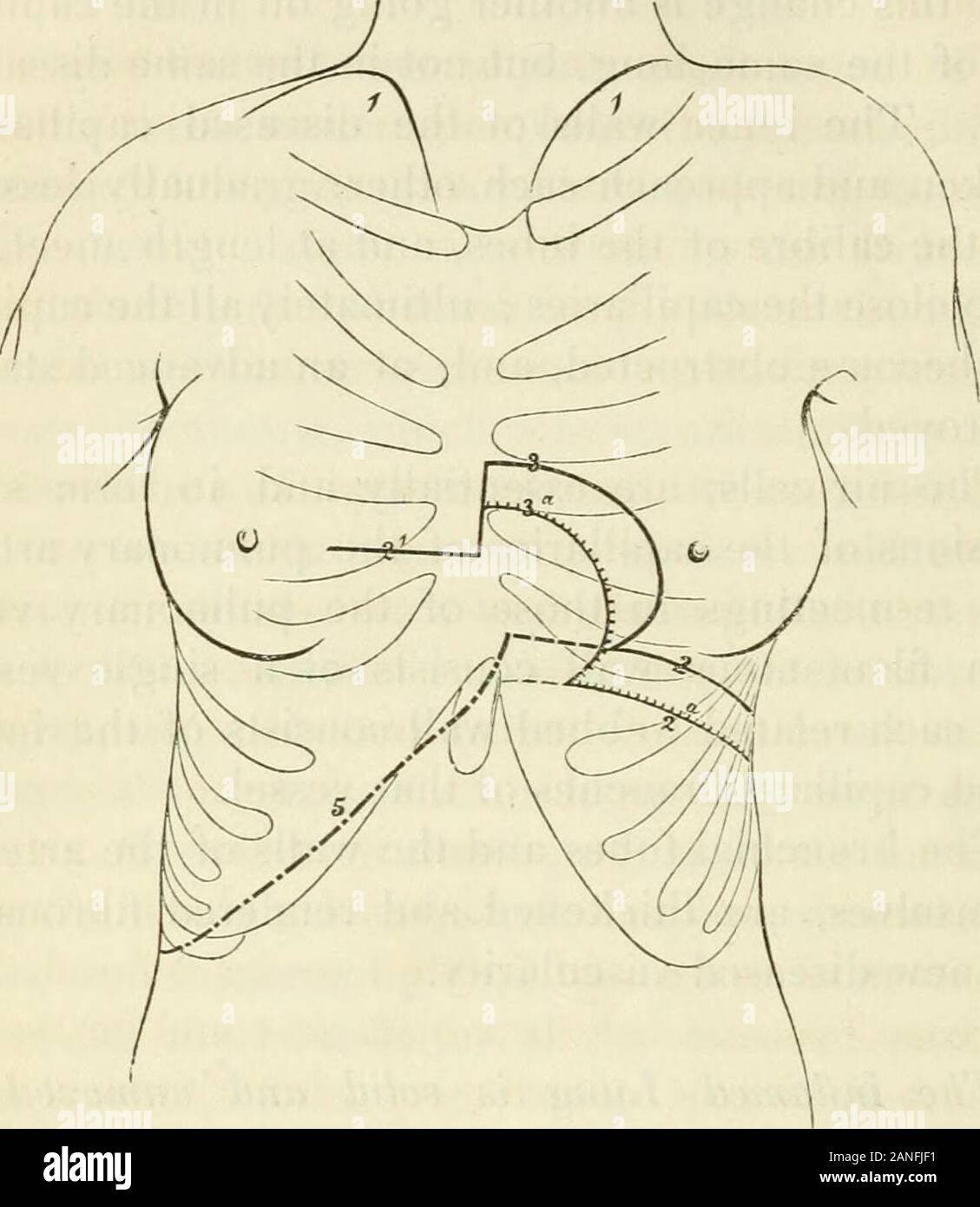 Transactions . ach mur filamenteux se compose d'un seul navire,et chaque mur est constitué de la palmure entre-lacé branches capillaire de ce navire. Les bronches et les murs de l'arteriesthemselves, sont épaissies et rendue par la nouvelle vascularisation fibreux malades. L'inflammation des poumons est solide et insensible. byrespiration-Lorsque la pneumonie affecte le wholelower d'un lobe lobe pulmonaire, qui est rendu;solides les parties d'elle ne peut pas se déplacer sur l'autre ; la partie inférieure de la poitrine est distendu définitivement,étant tout à fait non influencés par le mouvement respiratoire. État de l'e-poumons en santé. Banque D'Images