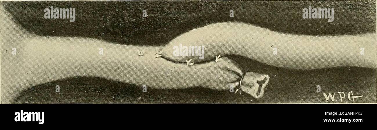 Gynécologie . Fig. 405.--anastomose urétérale (d'un bout à l'autre).L'extrémité distale de l'uretère est liée et d'une incision longitudinale faite dans le mur près de l'tiedend. La manière de placer le fil principal est montré (amplifiée à des fins d'illustra-tions) . Fin de l'anastomose latéro-latérale qui vient d'être décrit est la meilleure méthode si les extrémités coupées de l'uretère sont assez longtemps pour admettre la manipulation sans traction toomuch et sans trop d'interférences avec l'approvisionnement en sang-urétéral.Lorsque les extrémités sont trop courts pour l'opération précédente une anas-tomosis peut être effectuée de la manière indiquée Banque D'Images