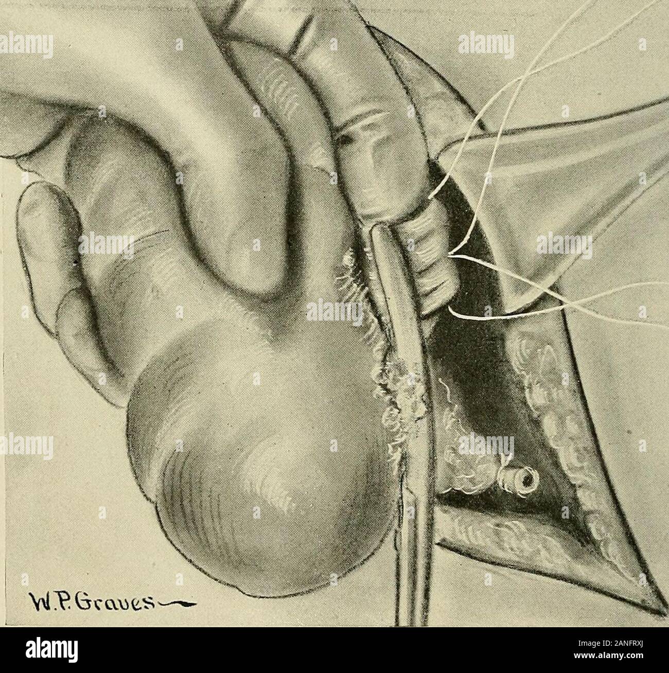 Gynécologie . j'^t3ca&gt;t.s Fig. 404.-Nephrectomy.Serrage et lier les vaisseaux rénaux. Après le bassin a été entièrement libéré, toutes les adhésions d'thekidney sont libérées, et la graisse sur les navires repoussé afin d'exposethem plus clairement. Le rein est livré entièrement à partir de la plaie, theforefinger de la main gauche mise en voir le pédicule. Le pédicule doit betied avec le plus grand soin. Une méthode pratique est de passer d'un lit ligatureinto ce pédicule avec un bout de l'aiguille. La tension sur le rein est alors renforcé et la slack-ligatures lié aussi loin de l'ki Banque D'Images