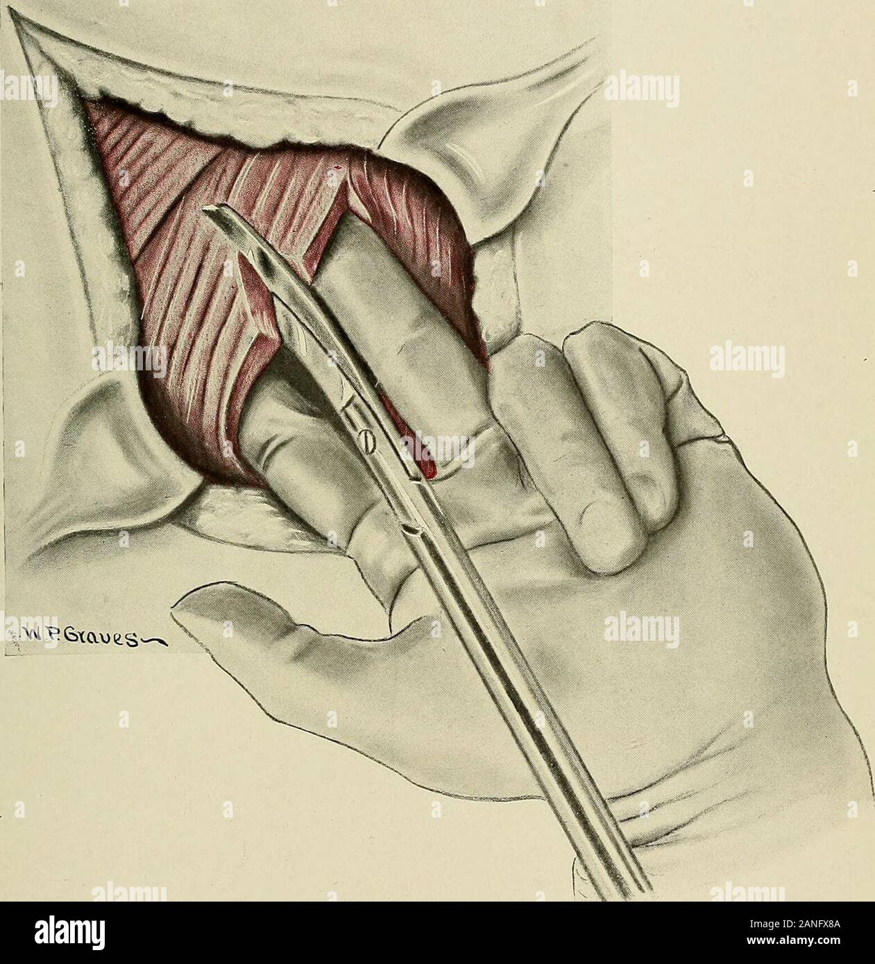 Gynécologie . uperior colonne vertébrale à travers les muscles abdominaux (obliques externes internes,oblique, fascia transversalis) et en coupant vers le haut à travers le latissimusdorsi posticus serratus et la musculature. Le structuresmay musculaire ou être coupées avant l'ouverture de l'aponévrose lombaire (fig. 401). Encore une autre méthode est la poêle incision de Kelly. Dans la peau d'une longue décision est prise. Les muscles abdominaux sont d'abord ouverte par le fractionnement de la comme McBurneys,fibres en opération pour l'appendicite. La blessure est tendue avec les doigts comme en Fig. 394. Une incision à partir de cette ouverture est alors rendu LES OPÉRATIONS SUR LES REINS Banque D'Images