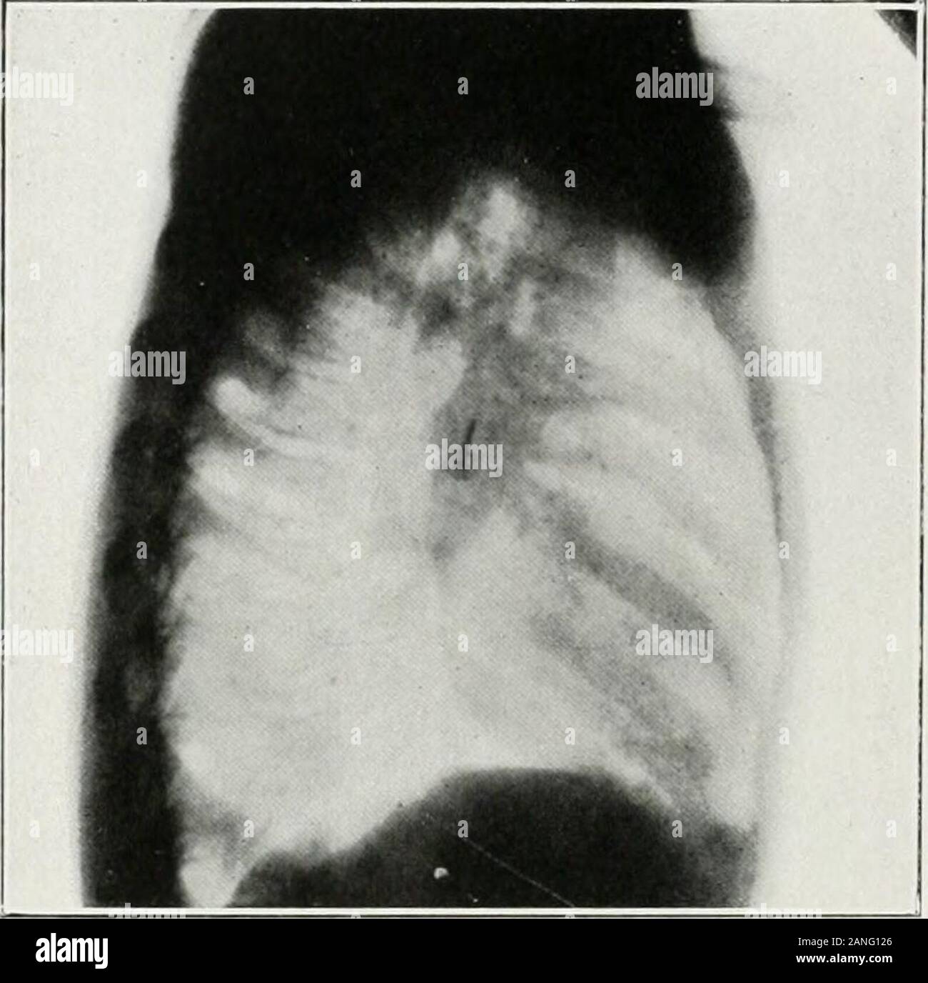 Peroral endoscopie et chirurgie laryngée . Fig. .--O^^raiilis.-Radio, anttro iostcrior latérale et|, montrant tack dans mainbrnnchiis gauche un iif lioy de dt-vcn ans. Tack enlevé par bronchoscopie orale witlnnit anes-thesia. (Radio.uraphs effectuée par le Dr George VV. plus sèches. Auteurs cas.^ LlSTRATlVU 404 Il.C.tr;s 111 IvMlOSCOPV nRKl j*IOR(;S liODIKS.. Banque D'Images