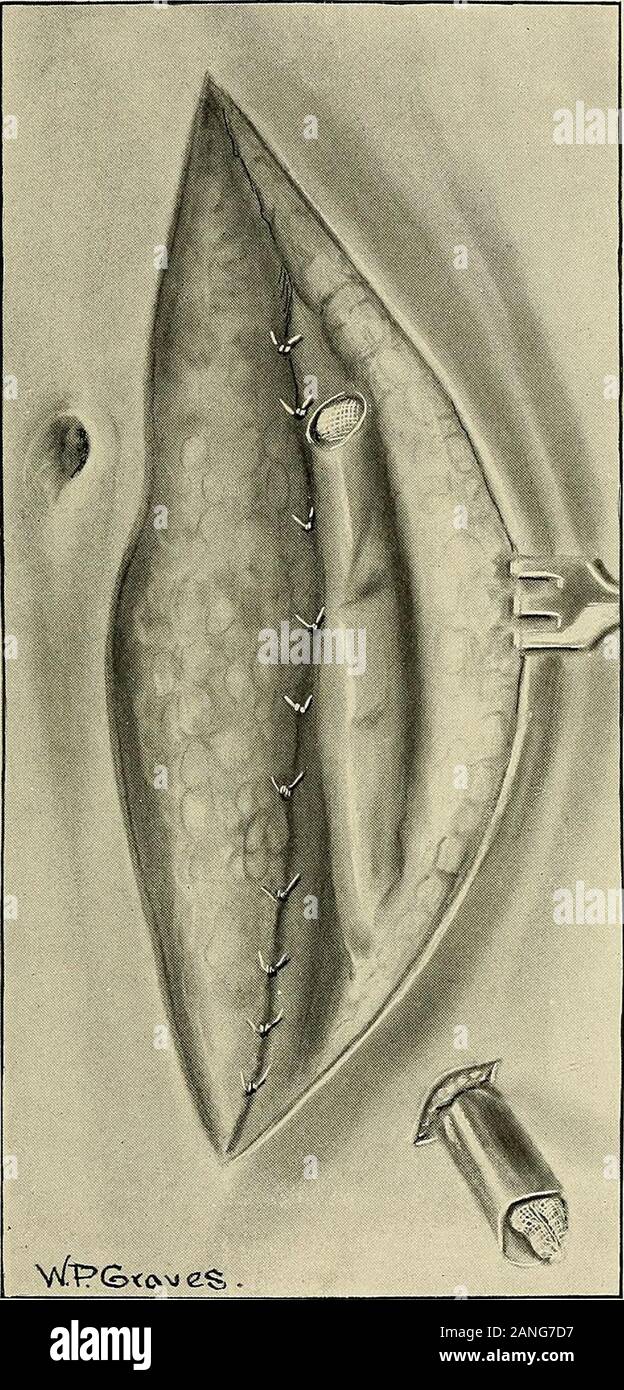 Gynécologie . par une seule rangée de points de toutes les poulies sont. S'il n'y a muchtension, ils devraient être de soie ou de lin. Si la tension n'est que modérée, forte le catgut (No. 2chromicized) est suffisant. Le fascia de la partie inférieure de la plaie est recouverte et cousaient withtwo rangées de catgut chromique interrompue sutures. ful. Il sera constaté que lorsque la moitié supérieure de la recti sont réunis dans thisway rassasier la moitié inférieure se trouvent étroitement ensemble, ce qui fait qu'aucune autre tensionto les approximative. Positionnement des fils dans le péritoine est cousu pour quelques pouces et les OPÉRATIONS SUR LES ABDOM Banque D'Images
