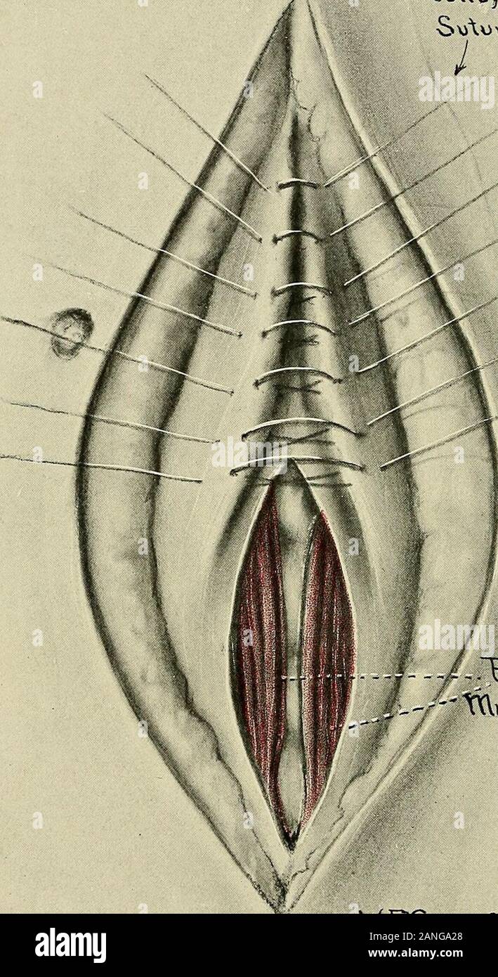 Gynécologie . V£GT(w".c ; fig. 377. pour les muscles grand droit de diastasis des grands droits (auteurs).Introduction de la poulie de suture par le fascia aux frontières de la muscles rectus. Twofingers de la main gauche sont insérées dans la plaie abdominale pour guider l'orientation de la suture et de ne pas blesser l'intestin sous-jacent. Les sutures ne doit pas être effectué à travers le mur entier.Il comprend seulement le carénage et une partie de l'indispensable tissu musculaire. d'unir les muscles. Si la tension est très grande, il est préférable d'utiliser l'ONA. 7 soie tressé doublé ou fort ,. Si la tension est Mo Banque D'Images