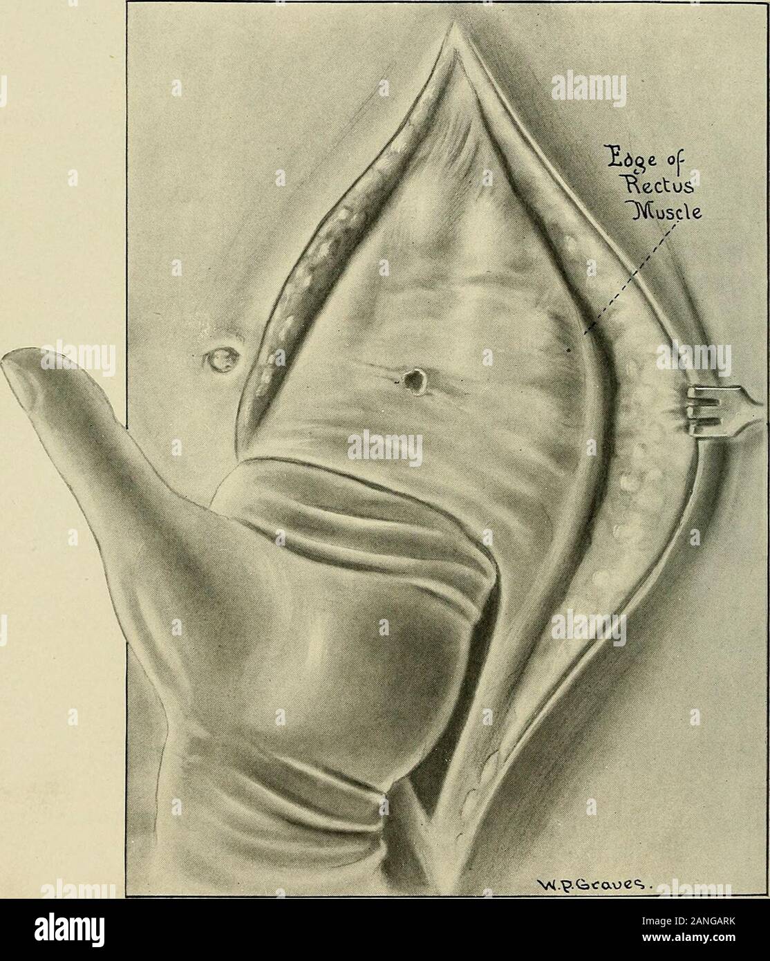 Gynécologie . al la relaxation de l'musclesextends séparation anormale au-dessus de l'ombilic. Lorsque l'opération pelvienne a été terminé theskin incision est élargie à environ 2 pouces au-dessus de l'ombilic. Le incisionis effectuée pas plus profond que la graisse. La peau et la couche de gras est alors dissectedwidely loin de l'aponévrose (la pièce jointe de l'ombilic beingsevered) jusqu'à ce que les bords du rectus muscles sont atteints. Il est important que l'aponévrose doit être bien nettoyé de la graisse. Lorsque tous les navires ont été liés, sont placés de manière à infold la paroi abdominale et mettre t Banque D'Images