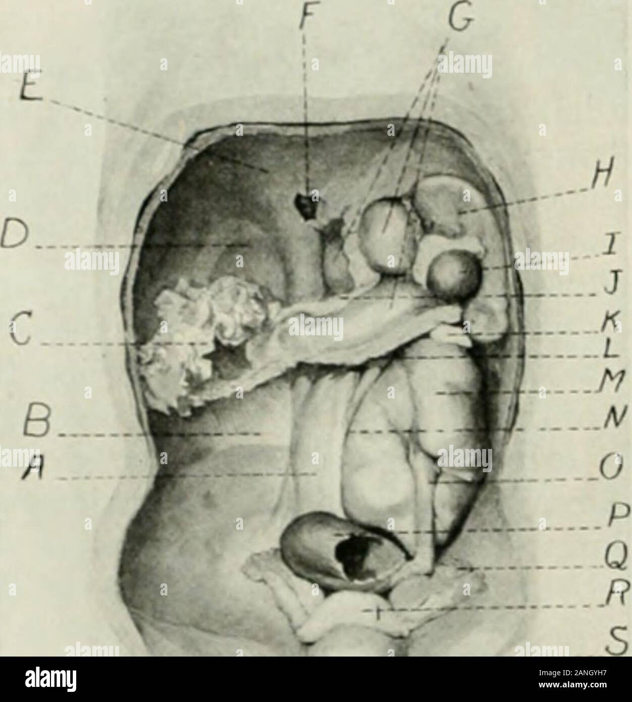 Le dossier anatomique reas. nothingunusual ont montré . Le volume des différents organes et parties de thebody étaient conpared avec Jacksons table sur le jirenatal liuinaii growthof le corps et aucun à l'exception de la partie supérieure de extremitiesfound gn ally hors de proportion avec la normale. Les anomalies de la circulation ont été trouvées dans le aixlominalaorta les ustensiles du pehis. Celles-ci sont illustrées à la figure5 qui est un schéma de circulation comme trouvé. Le •  inférieur !"• &gt ; tAKHON ASlll.niM. M) IIOWAUI) II. IIKISTOX^ otT est l'artère mésentérique aorte à un^leveltlinii imich hij lierre normal alors que le coel Banque D'Images