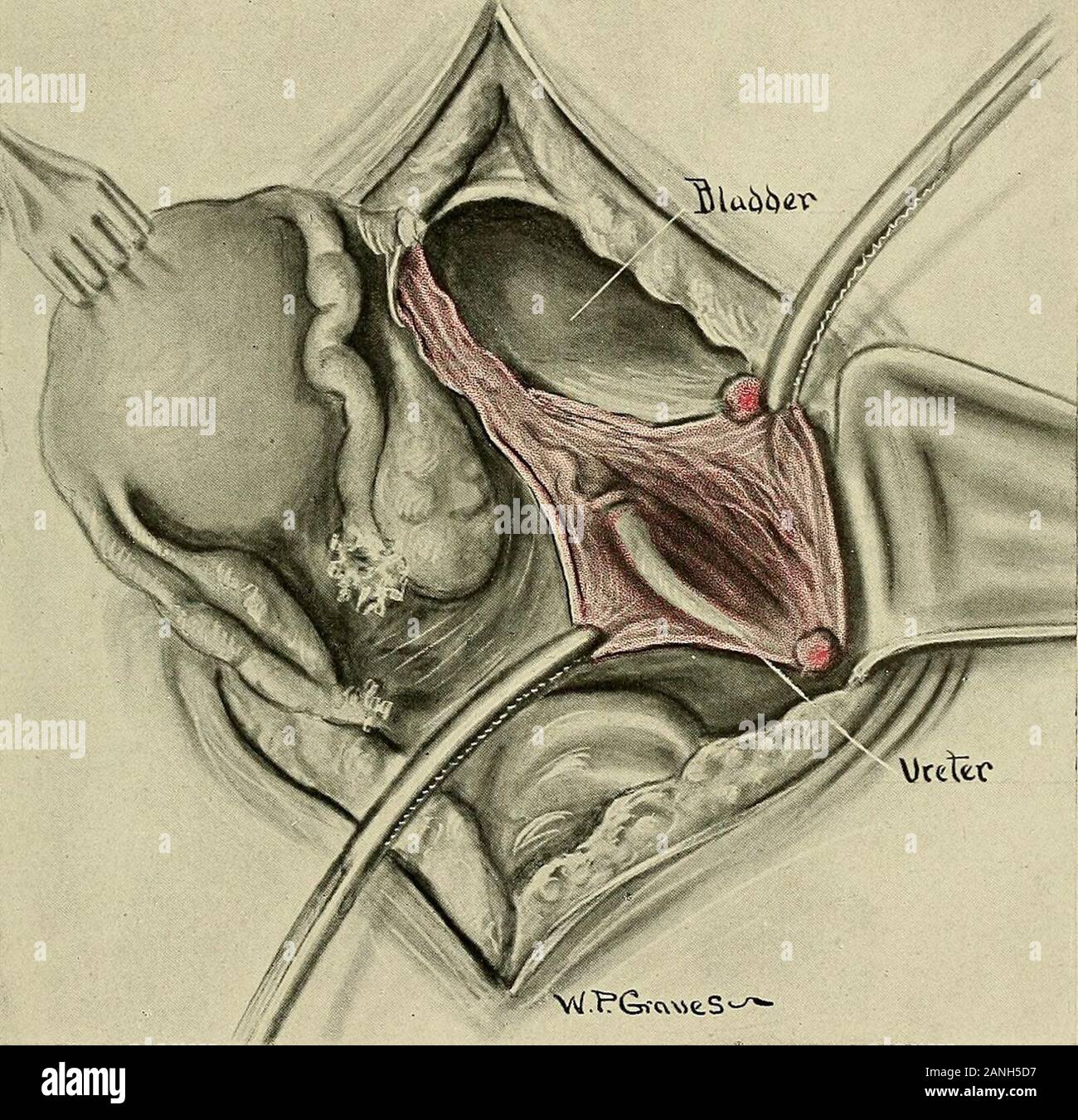 Gynécologie . soft, non-cordon pulsatile. Certains opérateurs, après l'identification de l'uretère, il et liftit de son lit en passant en dessous d'une bande de gaze ou d'une ligature ou quelques curvedinstrument. Nous avons l'habitude de priver l'uretère aussi peu que possible, en tant que maître de conférence avec son sang-alimentation prédispose à une nécrose et une fistule urétérale. Lorsque l'urètre a été isolé, l'étape suivante consiste à lier les vaisseaux utérins. Avec l'uretère comme guide, l'index est passé sous les vaisseaux utérins dans les opérations 639 hystérectomie direction de la vessie, puis poussé vers l'avant jusqu'à ce qu'il émerge Banque D'Images