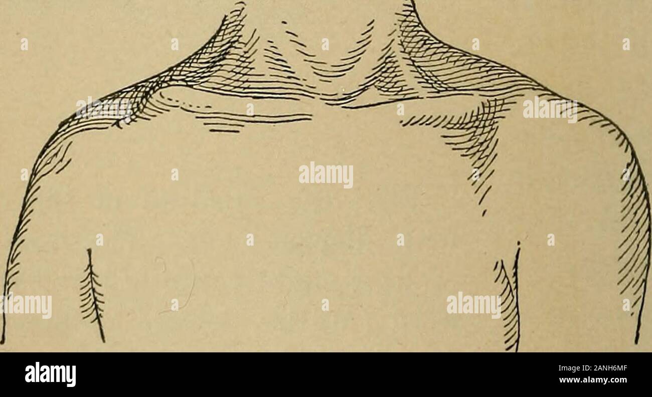 Atlas et exemple même de fractures et luxations traumatiques . thesternal niidclle een et tiers de l'os. Les fragments présents. markedoverriding Le fragment sternal est déplacé vers le haut par la pression de l'espace extra-fragment et l'attraction de l'sternocleidomastoidmuscle. Dans l'illustration le muscle sterno-cléido-mastoïdien est readilyrecognized ; derrière, la limite externe de la cou est formé par thetrapezius ; le muscle deltoïde est disséqués et la por-tion claviculaire du grand pectoral a été en partie supprimé. Dans thefenestra ainsi produit nous voyons la clavicule fracturée avec la s Banque D'Images