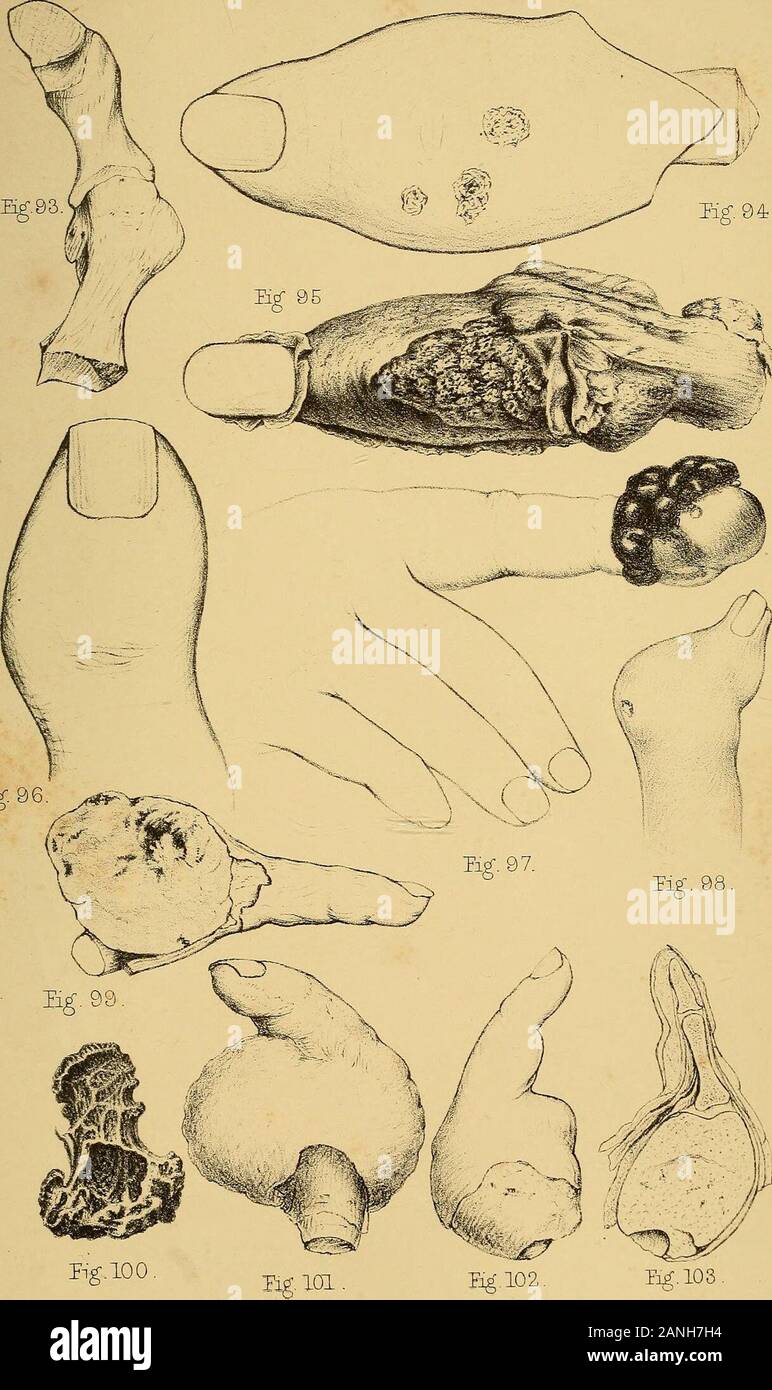 Les malformations, maladies et blessures des doigts et orteils et leur traitement chirurgical . 91. Harrisons Uta : PLAQUE IX. Fig. Page 93. Les os d'un gros orteil à partir d'un cas d'oignon, . 119 94. Caries aiguë de l'os d'un doigt, le résultat d'un accident, ........ 141 95. Le même doigt après la peau avait été disséqué, indiquant ainsi l'état de la pulpeuse parties molles, avec por-tions d'os carieuse couché dans eux, . .141 96. Synovite chronique de l-phalangienne du pouce, 126 97. De plus en plus de tumeurs Melanotic les parties molles à l'extrémité d'un doigt, . . 0,167 98. Tumeurs cartilagineuses Banque D'Images