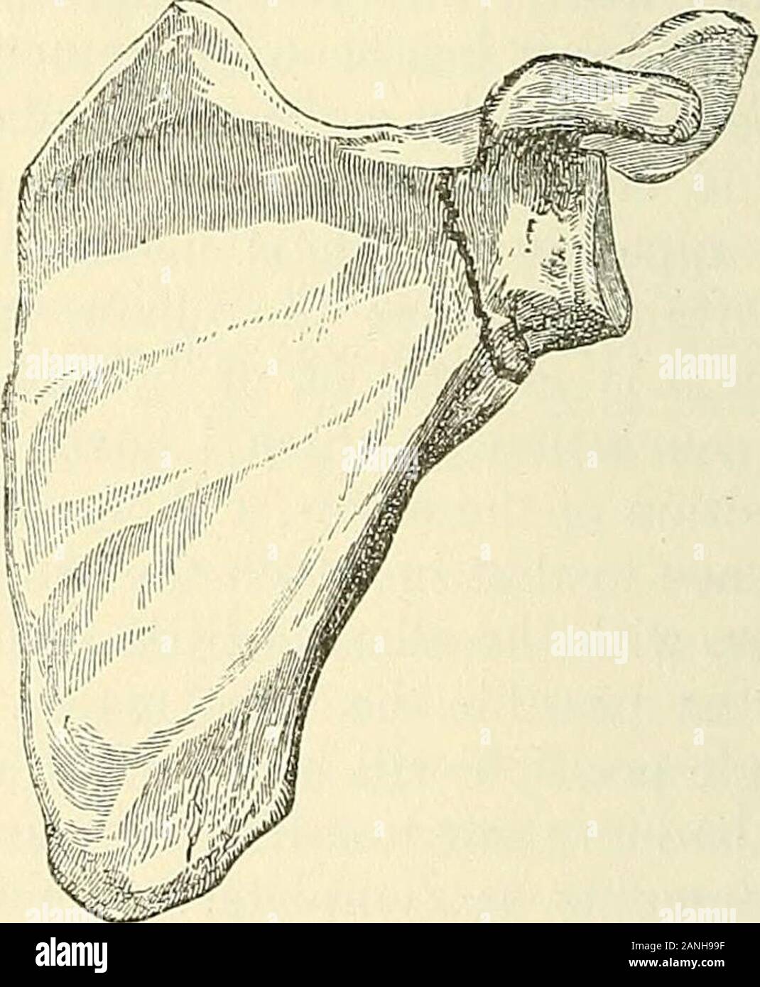 Un traité pratique sur les fractures et luxations . Fracture comminutive du theglenoid cavité.. À la cassure du col de la scapula;selon Sir Astley Cooper. Derrière la racine de l'Apophyse coracoïde, la chirurgie du cou, puis sa exister-ence est certaine ; pourtant, la fracture n'est pas commune. Duverney a signalé qu'un exemple, l'existence de laquelle il créé par la dissection. L'Apophyse coracoïde était cassé en même temps, mais le frac-ture à travers le col chirurgical était distincte de la présente ; et Sir Astley a recordedthree exemples dans lequel le diagnostic a été très clairement établie, mais pas actuall convention Banque D'Images