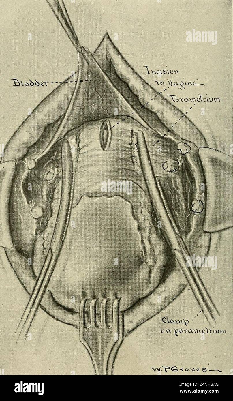 Gynécologie . Xp.Grauii.s- Fig. 333.-hystérectomie avec dépose du canal cervical.Les vaisseaux utérins ont été liés (ou serrés) et découper. Le canal cervical est hors conique avec un couteau. Des cas comme une endocervicitis guérit spontanément après une hyster-ectomy supra-vaginale, mais parfois l'inflammation persiste et le patient continuesafter l'opération de souffrir d'un irritant leukorrhea. Cette unpleasantconsequence peut être évitée par une suppression au cours de l'exploitation de l'cervicalmucous membrane, qui peut être réalisé soit par l'exécution d'une completehysterectomy, comme décrit b Banque D'Images