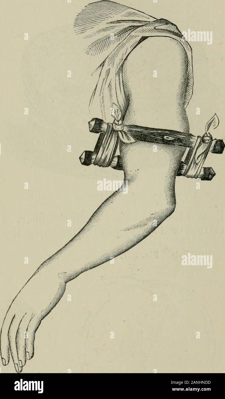 L'Encyclopédie internationale de chirurgie, un traité systématique sur la théorie et la pratique de la chirurgie . Torsion improvisés, ou les vieux soldats garrot(Esmarch.) double-sticlc garrot improvisé de VOlkers.(Eimarch.) comparativement peu de pression, cependant, si exercée au moyen d'un stickagainst la face interne du bras, est suffisant pour contrôler la circulation dans l'artère brachiale ; les muscles peut, de cette façon, être séparées de force,en partie, en partie de l'avant vers l'arrière, et l'artère repassé à plat sur l'uh-merus. Volkers garrot stick improvisés, qui atteint cet objet, mayread Banque D'Images