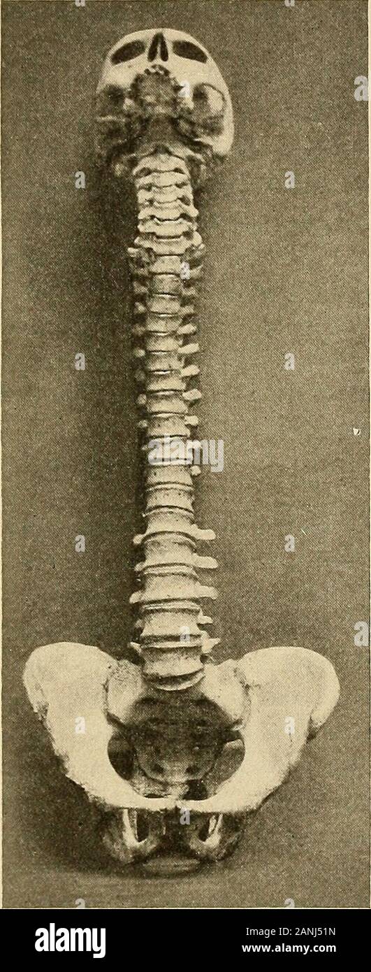 Courbure latérale de la colonne vertébrale et les épaules rondes . gham, 70 à 73 cm. ; Morris, 70 cm. ; et Krause, 72 à 75 cm.(le long des courbes), qui est de 45  %, de la longueur du corps. Therelative longueur de la régions distinctes est illustré dans le followingtable ^Cunningham : D wight ! Morris^ ^^^ Beaunois^^^ Femmes région cervicale 13-140111. 12,5 cm. 10,8 cm. 13,3 cm. 12.1cm. Région dorsale 27-29 cm. 27,5 cm. 27,0 cm. 28,7 cm. 26,5 cm, région lombaire 12-15 cm. 17,5 cm. 16,8 cm. 19,9 cm. 18,7 cm. Il est souvent affirmé que la longueur de la colonne vertébrale dans différents en-individus est assez constant, mais Dwights figu Banque D'Images