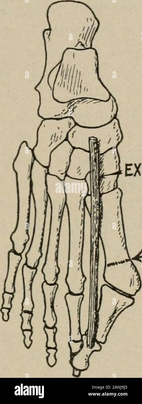 La chirurgie opératoire, pour les étudiants et praticiens . themetatarsal commune ci-dessus, entre les os cunéiformes et interne, s'ouvre et le méta-tarsien énucléation hors de son lit de parties molles, de coupe avec l'arêtede le couteau près de la surface de l'os. Les tendons du gros orteil sont coupés courts au-dessus au niveau des thetarso-métatarsiennes joint. Il n'est pas nécessaire d'utiliser un garrot dans thisamputation. Navires jaillissant sont pris et lié, et après la purge-ing a été contrôlé la plaie est fermée avec plusieurs points de suture. interruptedcatgut L'incision peut être placé sur le côté du pied AMPUT Banque D'Images