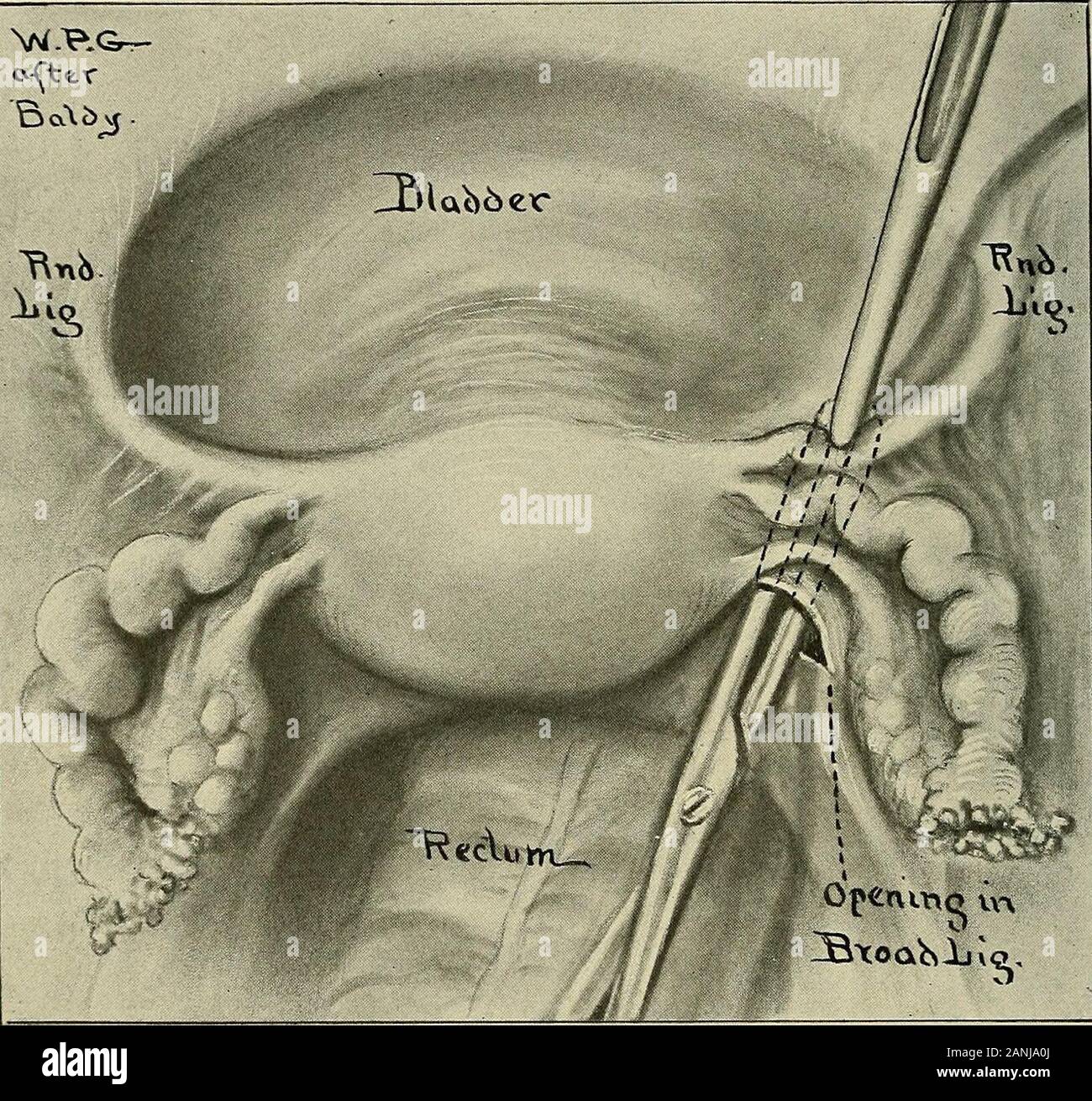 Gynécologie . arly normale que doesany d'autres opérations. Elle est également dépourvue de danger à partir de l'accouchement ou à partir de la com-complications d'occlusion intestinale. L'opération est effectuée dans la position de Trendelenburg. La Liga large-ment du côté droit est percé par un collier de mi-longueur à un point près d'theuterus et directement sous le ligament ovarien. Le ligament rond est thengrasped par forceps pouce à un point environ un tiers de la longueur du ligament 586 gynécologie de la fin de l'utérus le ligament s'effectue au moyen de forceps pouce dansle morsure de la pince de perforation, qui ainsi profiter de Banque D'Images