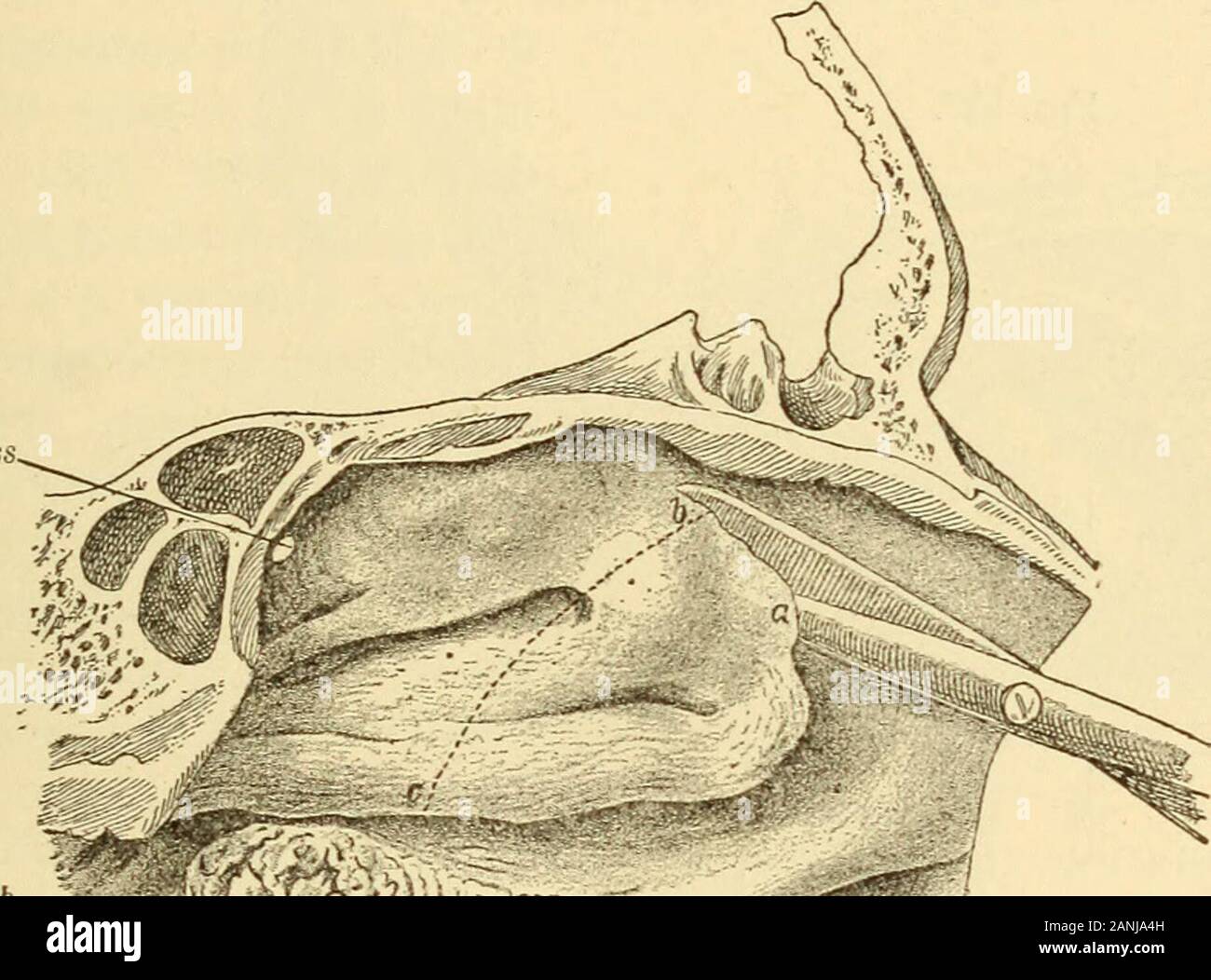 Un texte-livre sur les maladies de l'oreille, du nez et de la gorge . Le kyste dentaire entrant dans l'antre d'Highmore,découpe à travers dans le sens de la largeur. (Heymann.)suis, antre ; ic, turbinal ; zc, kyste dentaire ; d,racine de dent à partir de laquelle le kyste est originaire. EMIYEMA L'ANTRE DES maxillaires. Uiiciuatus 369, qui est la prochaine percée de la lame des ciseaux et rojecting^itsl partie coupée. Cette opération expose l'infundibulum,qui peuvent ensuite être readilj hypertrox^débarrassée des masses d'hic par ofnasal pinces de coupe, comme Griinwalds. Si les ouvertures naturelles befound trop petites ; elles peuvent être agrandies Banque D'Images