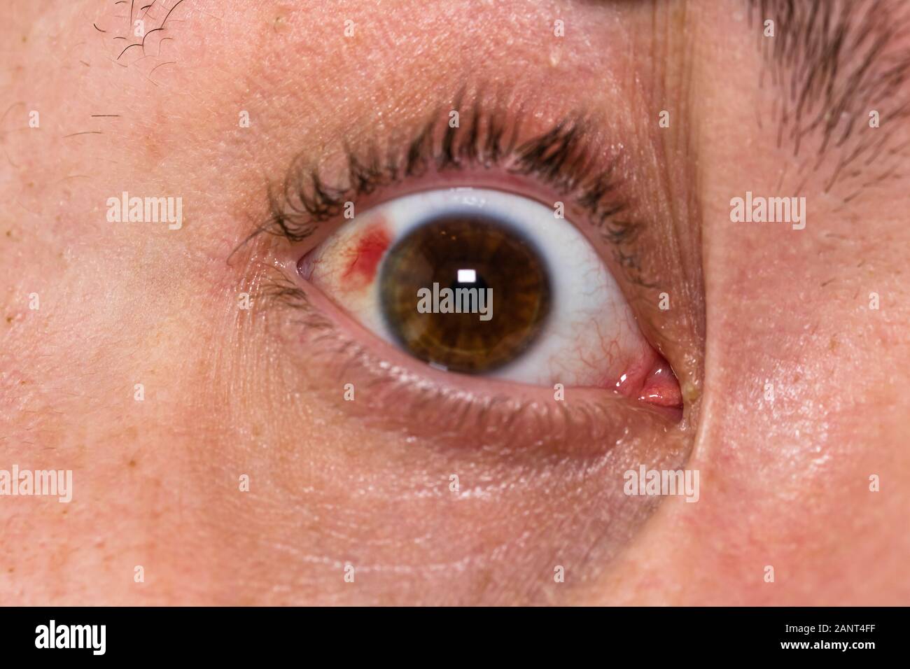 Blessure à l'œil, jeune homme avec burst vaisseau sanguin dans l'œil, de la fatigue, des problèmes de vaisseaux sanguins Banque D'Images