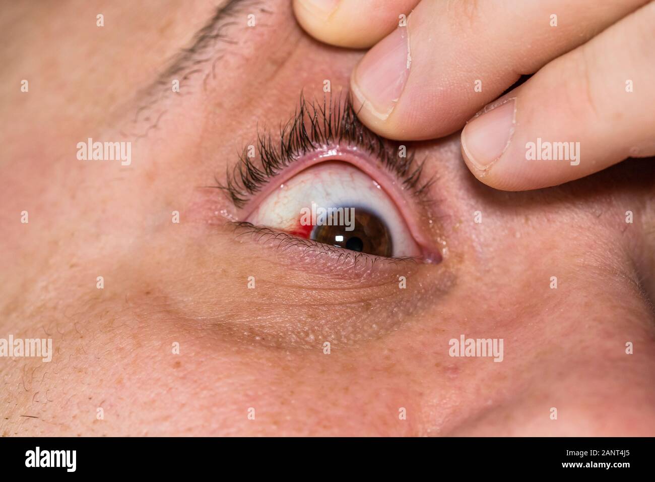 éclatement du vaisseau sanguin Banque de photographies et d’images à haute résolution Alamy