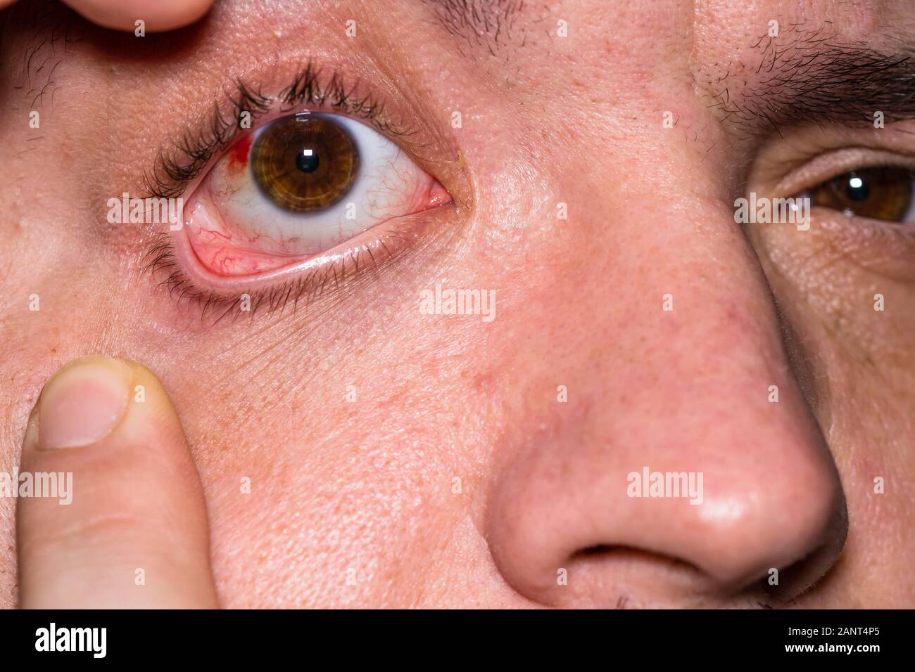 œil Injecte De Sang Yeux Banque D Image Et Photos Alamy