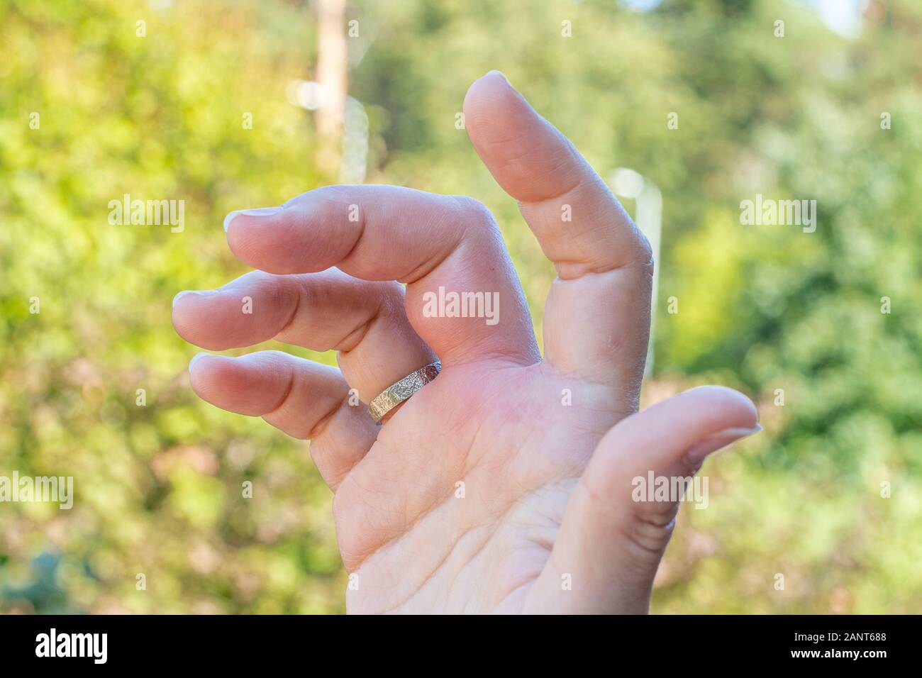 Une main droite avec une piqûre d'abeille mark, l'enflure, gonflement des mains, des doigts la main après une piqûre d'abeille pendant un jour d'été Banque D'Images