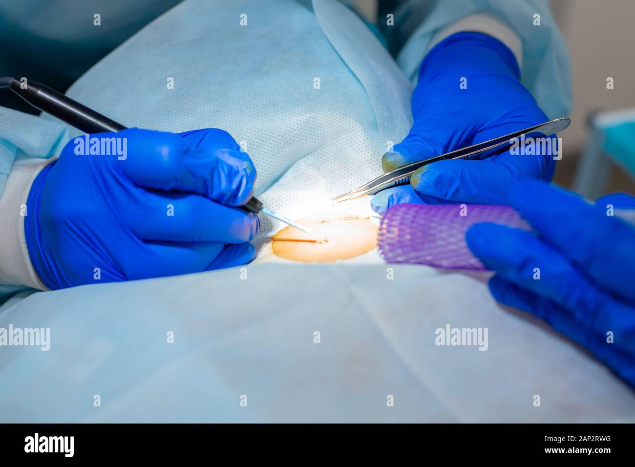 Close-up chirurgien burns une taupe sur le dos du patient. Procédure de chirurgie de déplacement de taupe. Banque D'Images