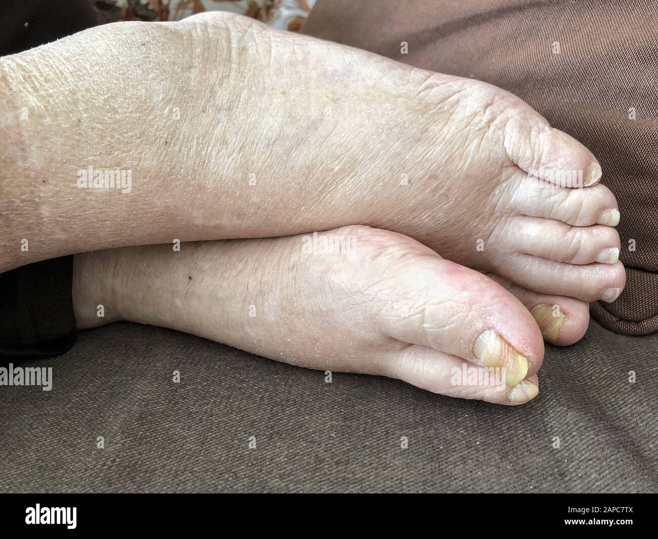 pieds d'un patient qui a un œdème pulmonaire avec des ongles endommagés à cause de champignon et d'athlète Banque D'Images