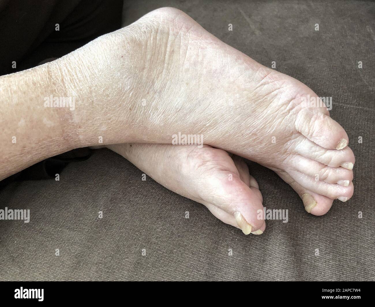 pieds d'un patient qui a un œdème pulmonaire avec des ongles endommagés à cause de champignon et d'athlète Banque D'Images