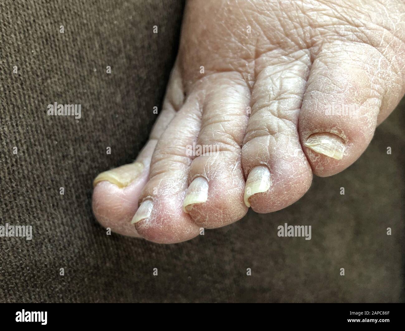 gros plan du pied femelle avec des ongles endommagés à cause du champignon Banque D'Images